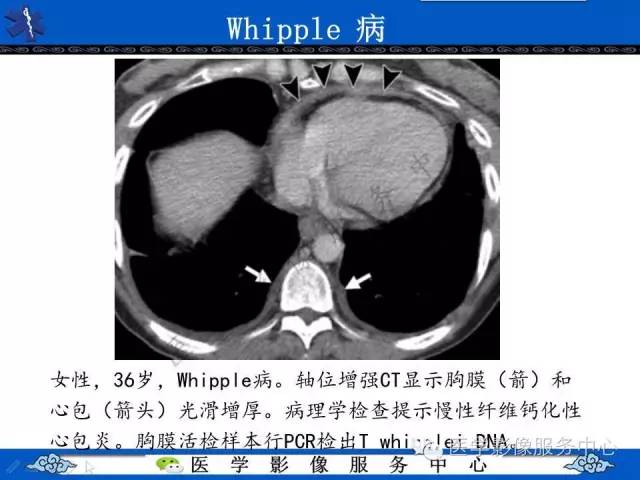【PPT】胸部组织细胞病变的影像学表现