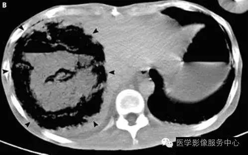 【病例】肝脓肿1例CT影像表现