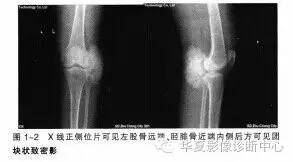 肿瘤样钙质沉着症