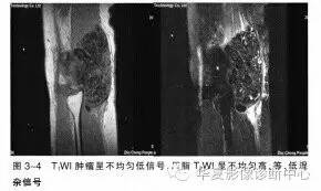 肿瘤样钙质沉着症 肿瘤样钙质沉着症
