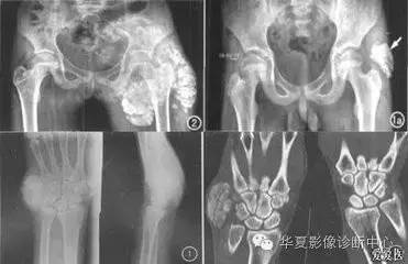 肿瘤样钙质沉着症 肿瘤样钙质沉着症