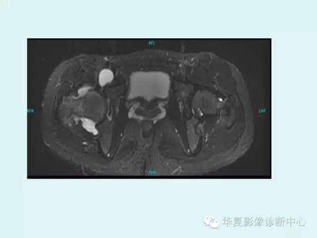 【PPT】大转子周围滑囊炎