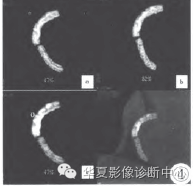 【病例】CT平扫诊断冠状动脉支架断裂1例