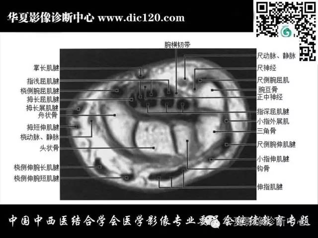 【PPT】腕关节解剖常见病影像诊断