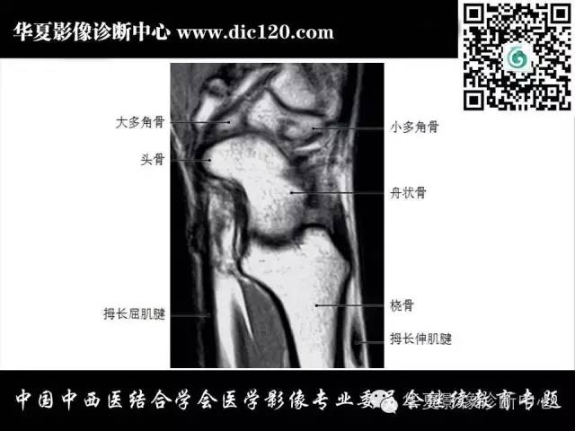 【PPT】腕关节解剖常见病影像诊断