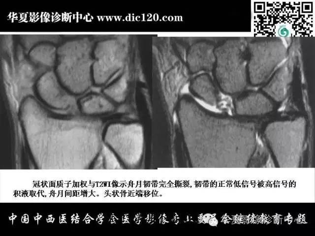 【PPT】腕关节解剖常见病影像诊断