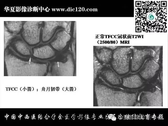【PPT】腕关节解剖常见病影像诊断