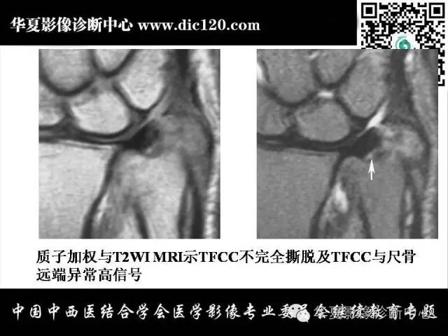 【PPT】腕关节解剖常见病影像诊断