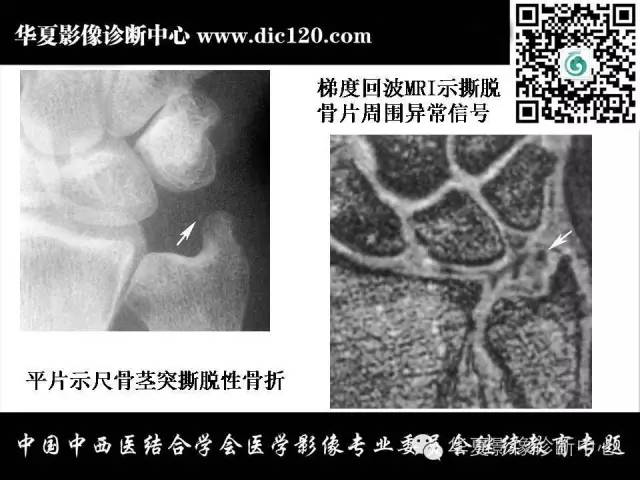 【PPT】腕关节解剖常见病影像诊断