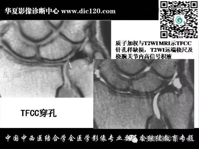 【PPT】腕关节解剖常见病影像诊断