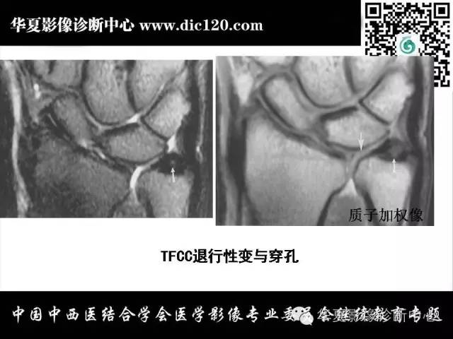 【PPT】腕关节解剖常见病影像诊断