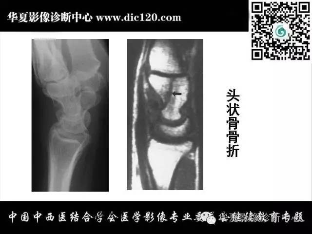【PPT】腕关节解剖常见病影像诊断