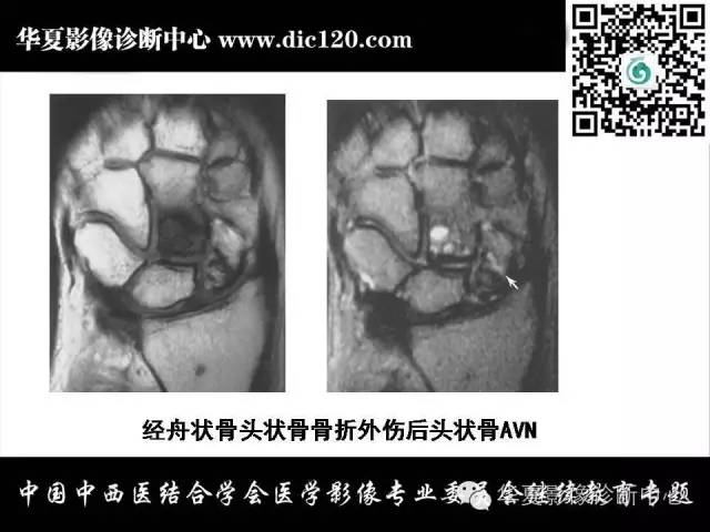 【PPT】腕关节解剖常见病影像诊断