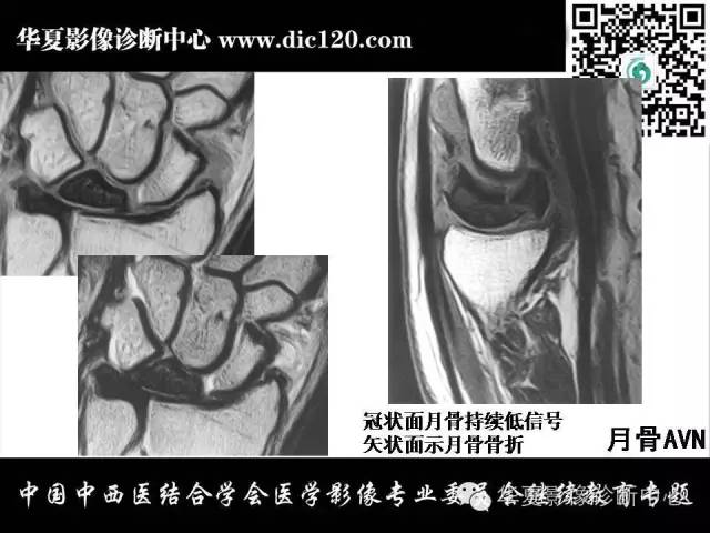 【PPT】腕关节解剖常见病影像诊断