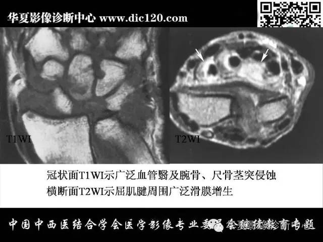 【PPT】腕关节解剖常见病影像诊断