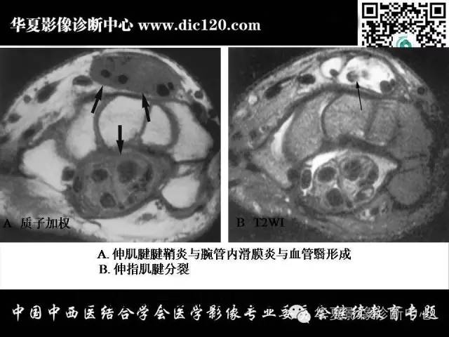 【PPT】腕关节解剖常见病影像诊断
