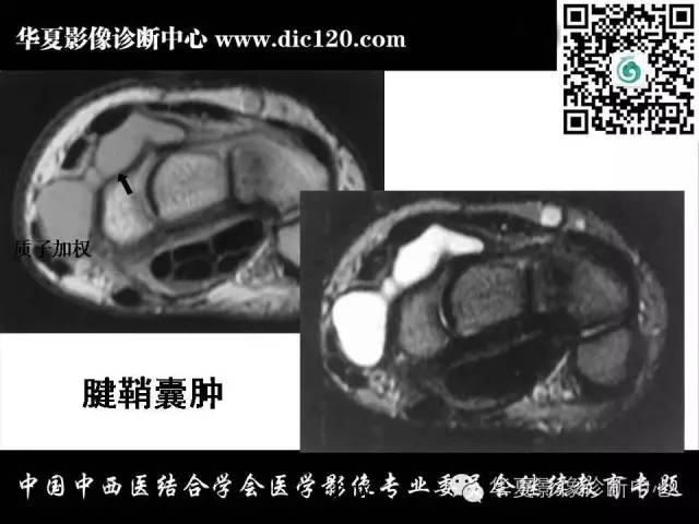 【PPT】腕关节解剖常见病影像诊断