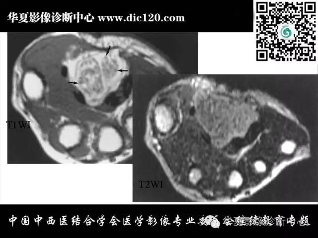 【PPT】腕关节解剖常见病影像诊断
