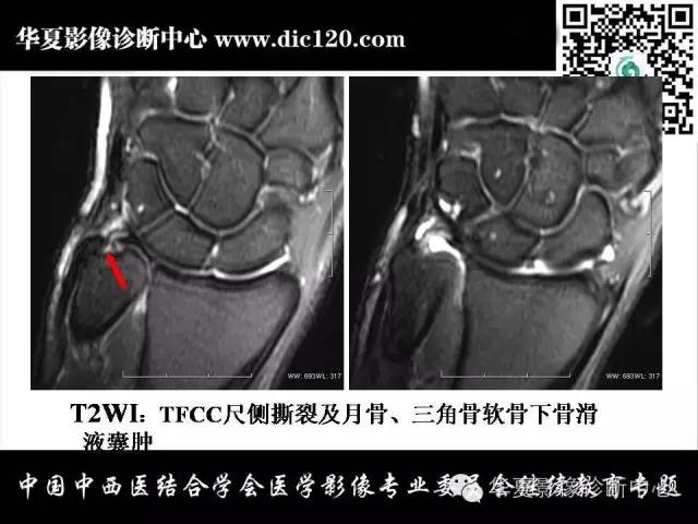 【PPT】腕关节解剖常见病影像诊断
