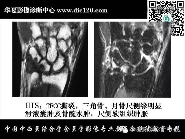 【PPT】腕关节解剖常见病影像诊断