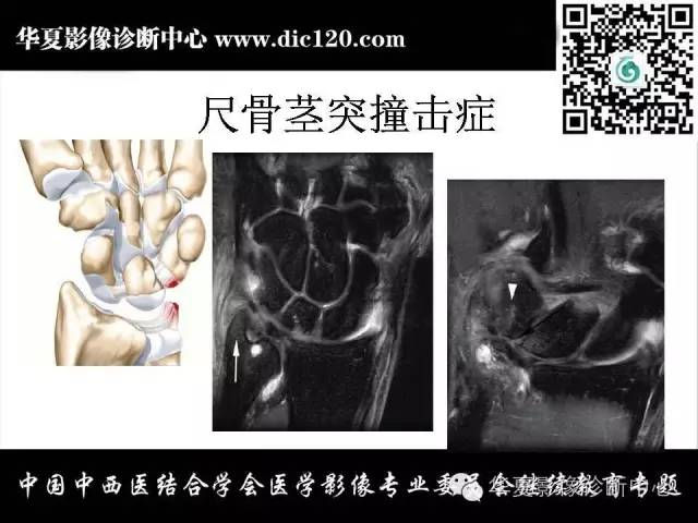 【PPT】腕关节解剖常见病影像诊断