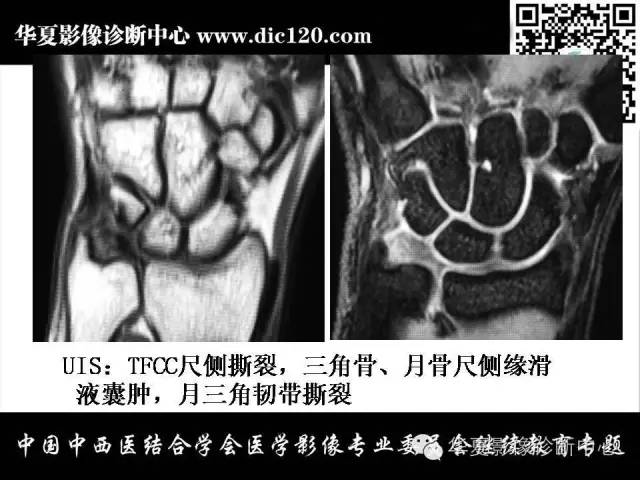 【PPT】腕关节解剖常见病影像诊断