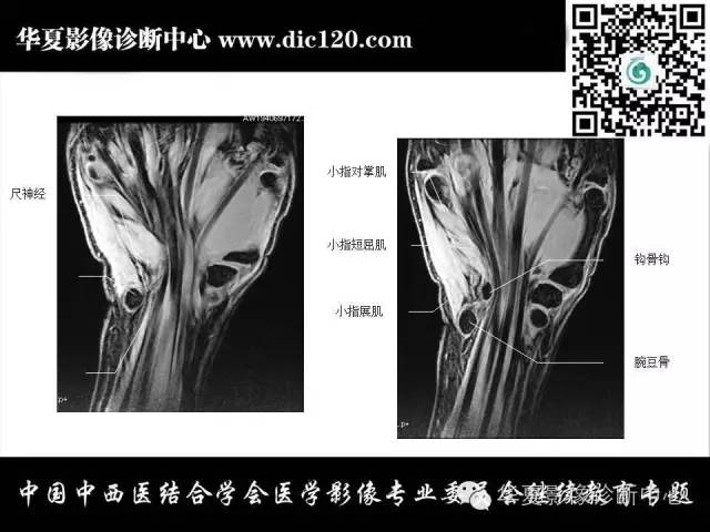 【PPT】腕关节解剖常见病影像诊断