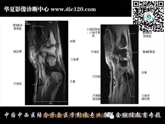 【PPT】腕关节解剖常见病影像诊断