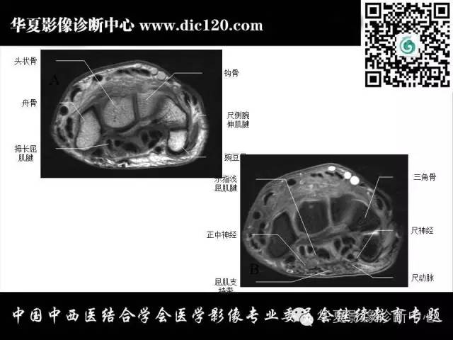 【PPT】腕关节解剖常见病影像诊断