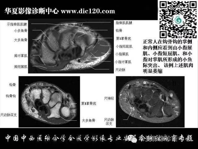 【PPT】腕关节解剖常见病影像诊断