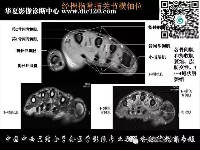 【PPT】腕关节解剖常见病影像诊断