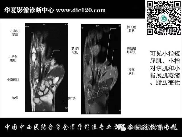 【PPT】腕关节解剖常见病影像诊断
