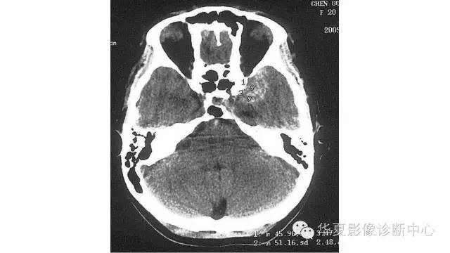 【病例】鞍旁脑外海绵状血管瘤1例MR影像表现