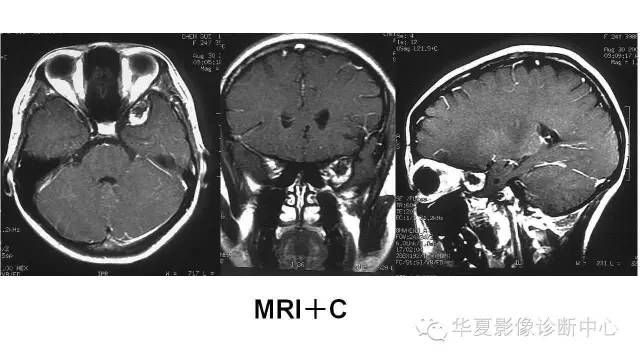 【病例】鞍旁脑外海绵状血管瘤1例MR影像表现