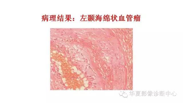 【病例】鞍旁脑外海绵状血管瘤1例MR影像表现
