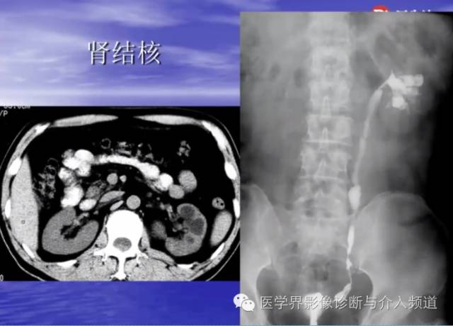 肾脏病变的CT诊断,你掌握了吗? 肾脏病变的CT诊断,你掌握了吗?