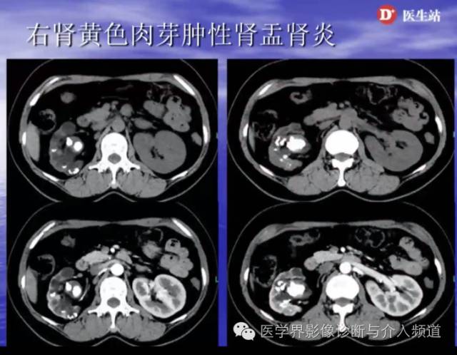 肾脏病变的CT诊断,你掌握了吗? 肾脏病变的CT诊断,你掌握了吗?