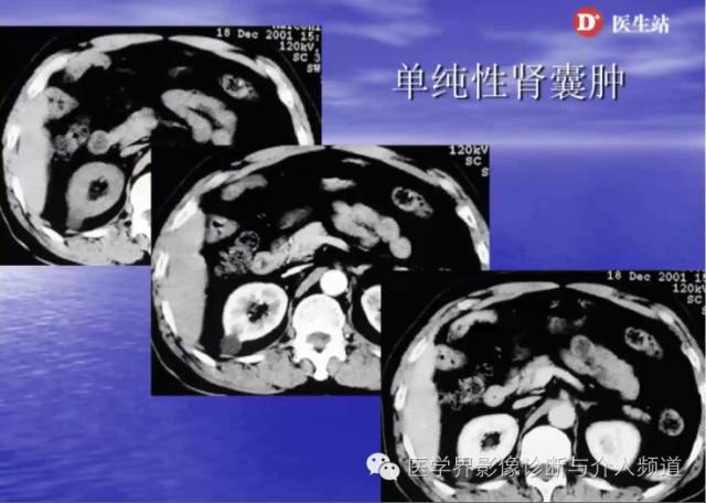 肾脏病变的CT诊断,你掌握了吗? 肾脏病变的CT诊断,你掌握了吗?