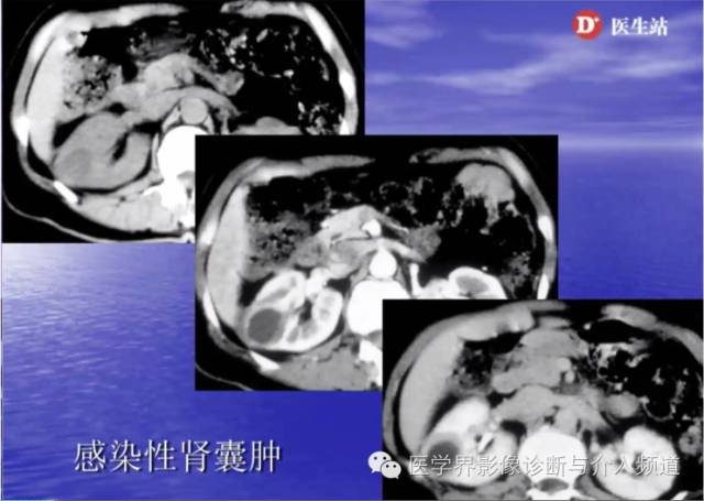 肾脏病变的CT诊断,你掌握了吗? 肾脏病变的CT诊断,你掌握了吗?