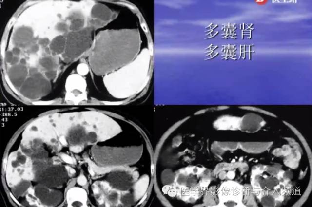 肾脏病变的CT诊断,你掌握了吗? 肾脏病变的CT诊断,你掌握了吗?