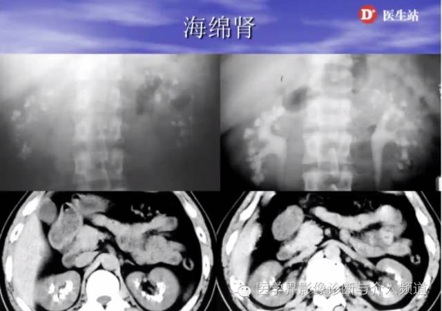 肾脏病变的CT诊断,你掌握了吗? 肾脏病变的CT诊断,你掌握了吗?
