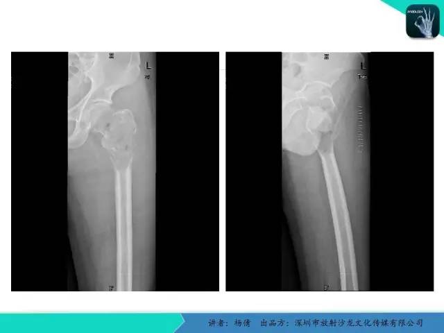 【病例】动脉瘤样骨囊肿1例影像分析