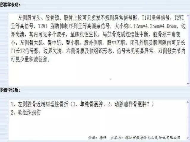 【病例】动脉瘤样骨囊肿1例影像分析