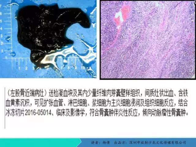 【病例】动脉瘤样骨囊肿1例影像分析