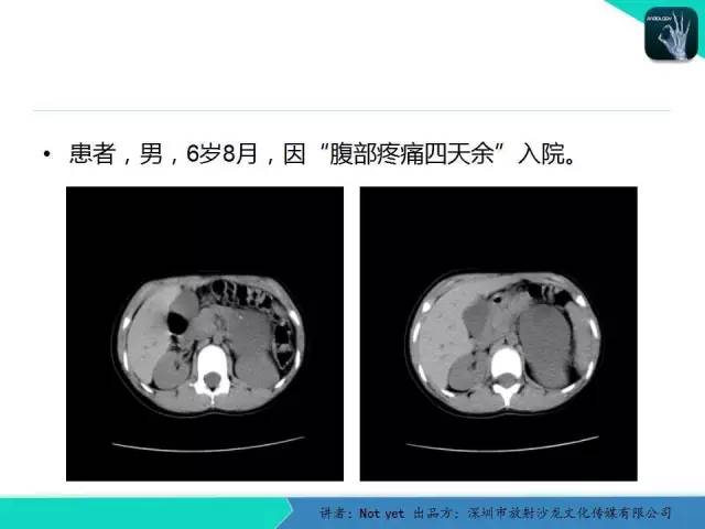 【病例】肾上腺节细胞神经瘤1例CT影像分诊断与鉴别