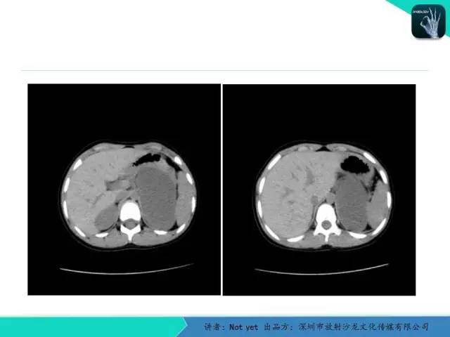 【病例】肾上腺节细胞神经瘤1例CT影像分诊断与鉴别