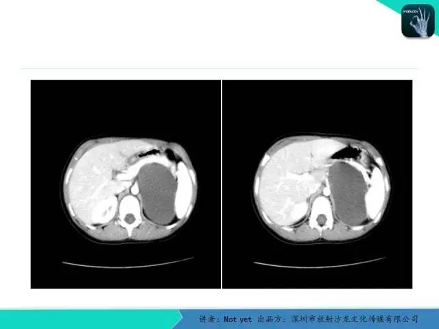 【病例】肾上腺节细胞神经瘤1例CT影像分诊断与鉴别