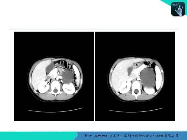 【病例】肾上腺节细胞神经瘤1例CT影像分诊断与鉴别