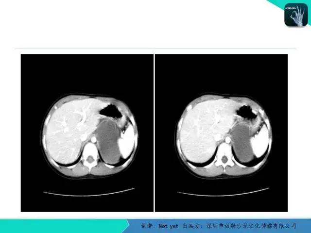 【病例】肾上腺节细胞神经瘤1例CT影像分诊断与鉴别