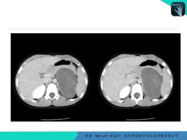 【病例】肾上腺节细胞神经瘤1例CT影像分诊断与鉴别